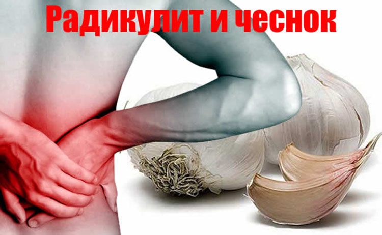 Чеснок, как лучший и быстрейший исцелитель от приступа радикулита radikulit chesnok